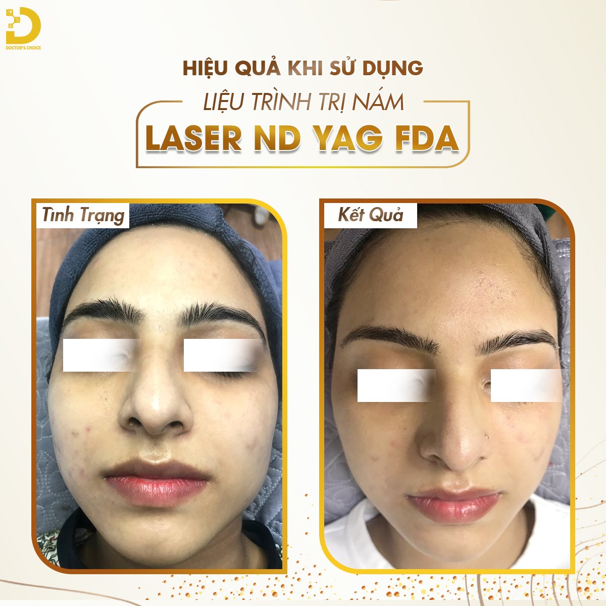 Trị nám bằng laser mang lại nhiều hiệu quả 