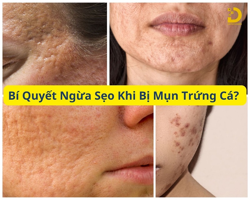 Cách ngăn ngừa sẹo khi bị mụn trứng cá