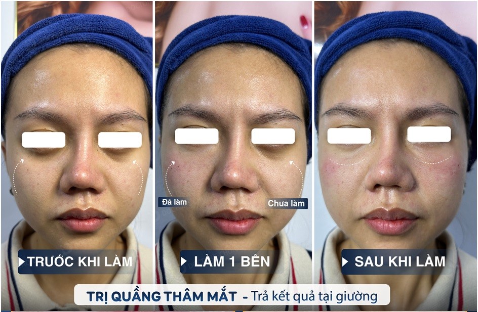 Trị Thâm Bằng Laser: Ưu Nhược Điểm, Công Nghệ Nào Tốt? 16 Kết quả trị thâm quầng mắt