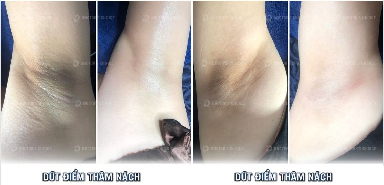 Trị Thâm Bằng Laser: Ưu Nhược Điểm, Công Nghệ Nào Tốt? 17 Kết quả trị thâm nách