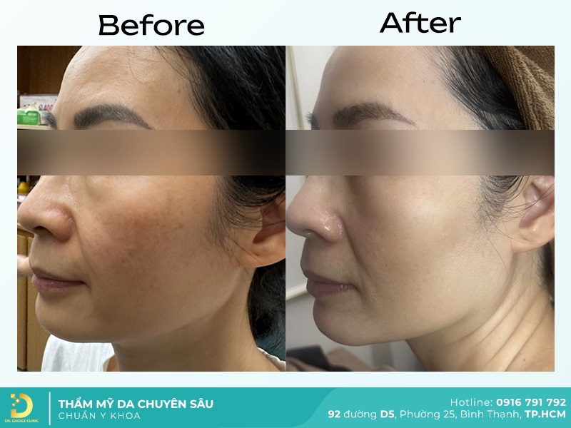 anh truoc sau dieu tri 1