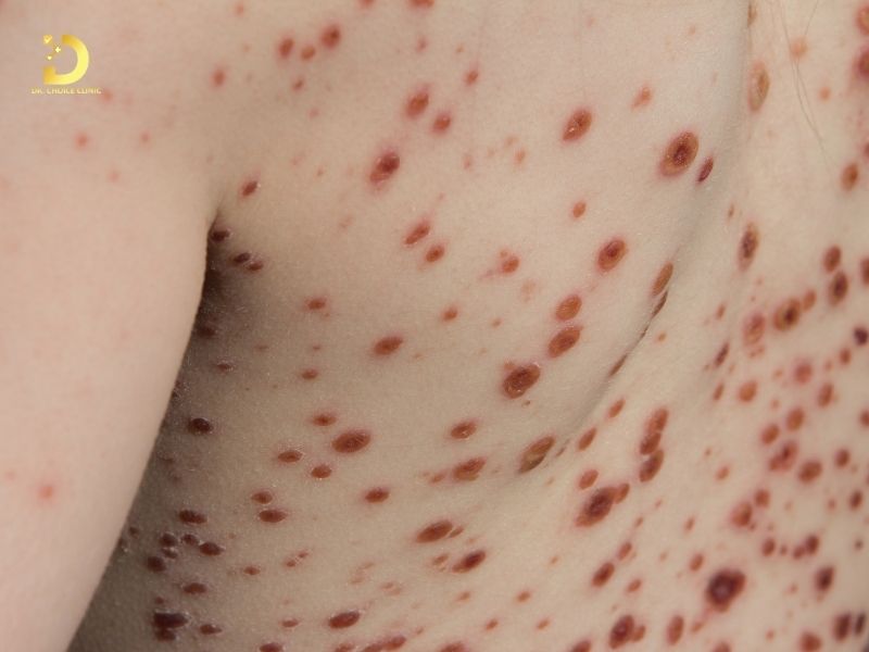 Hình ảnh bệnh thủy đậu