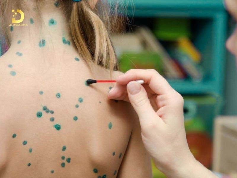 Bôi thuốc sát trùng làm dịu