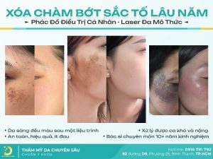 bớt sắc tố da
