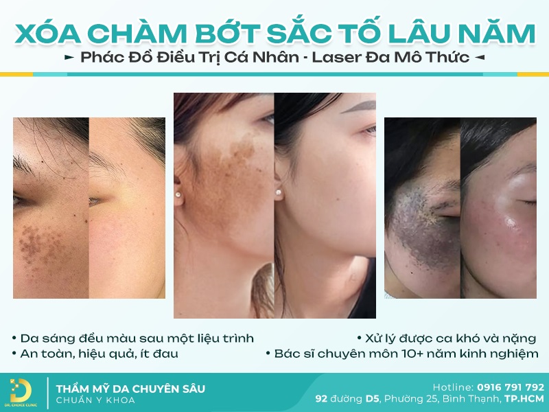 bớt sắc tố da