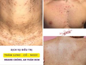 Dịch vụ điều trị thâm lưng - cổ - ngực