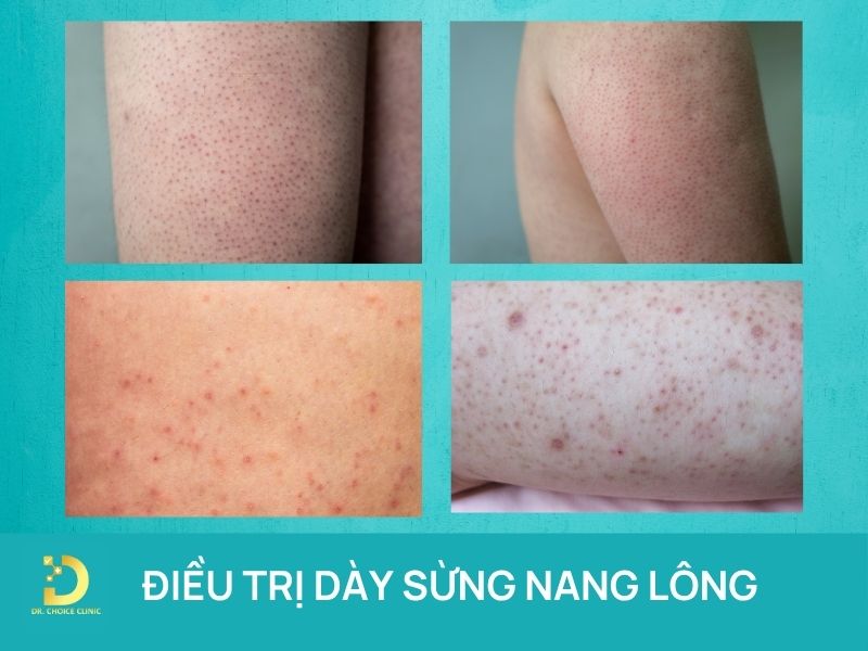Điều trị dày sừng nang lông chuẩn y khoa tại HCM