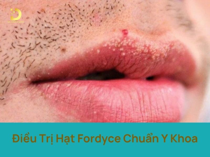dieu tri hat fordyce