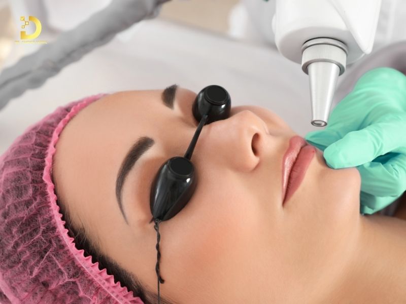 Giải Pháp Điều Trị Hạt Fordyce Chuẩn Y Khoa – An Toàn, Hiệu Quả Tại TP.HCM 10 Điều trị hạt Fordyce bằng laser
