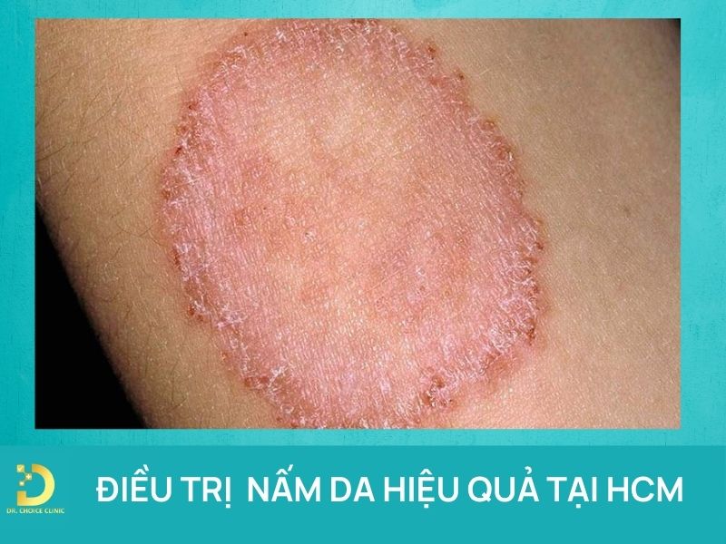 Điều trị nấm da hiệu quả tại HCM