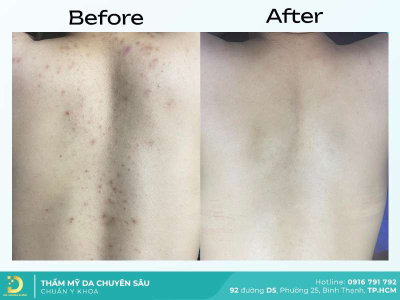 Trị thâm lưng.