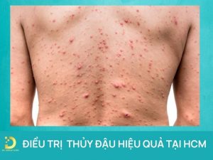 Điều trị thủy đậu an toàn hiệu quả tại HCM