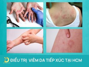 Điều trị viêm da tiếp xúc tại HCM