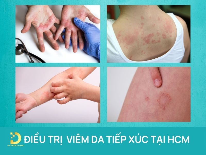 Điều trị viêm da tiếp xúc tại HCM