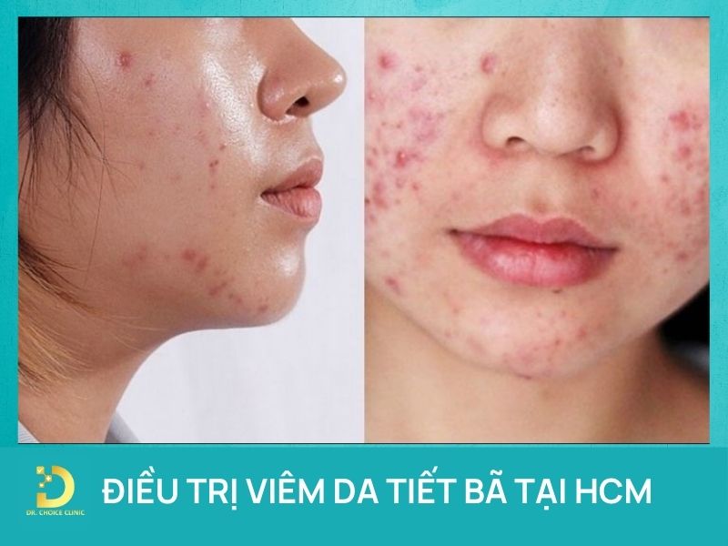 Điều trị viêm da tiết bã chuẩn y khoa tại HCM