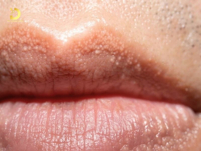 Giải Pháp Điều Trị Hạt Fordyce Chuẩn Y Khoa – An Toàn, Hiệu Quả Tại TP.HCM 9 hat fordyce moi