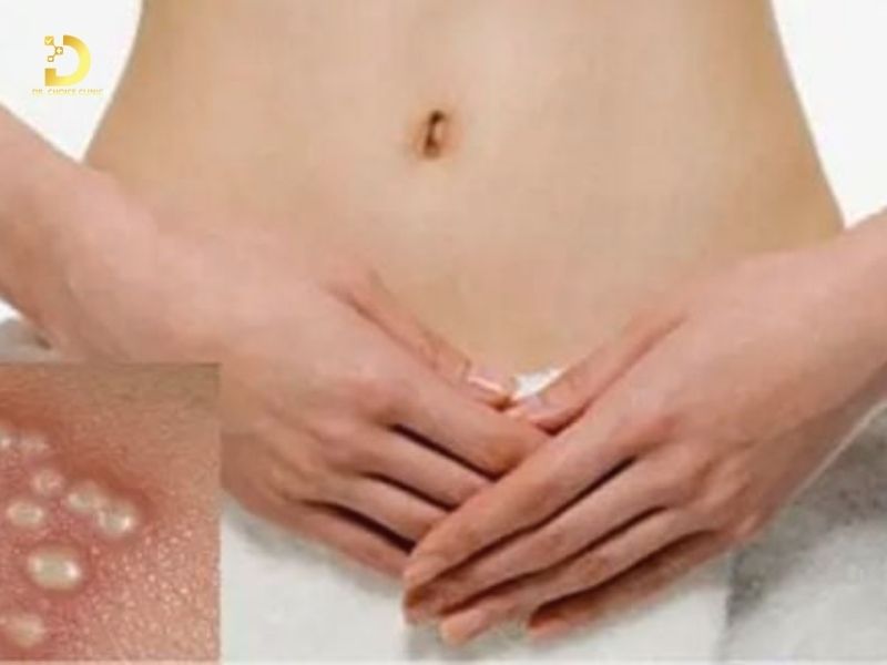 Giải Pháp Điều Trị Hạt Fordyce Chuẩn Y Khoa – An Toàn, Hiệu Quả Tại TP.HCM 8 Hạt Fordyce thường xuất hiện vùng kín