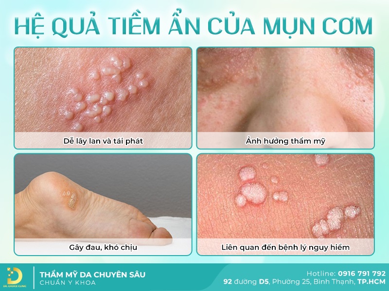Hệ quả tiềm ẩn của mụn ẩn