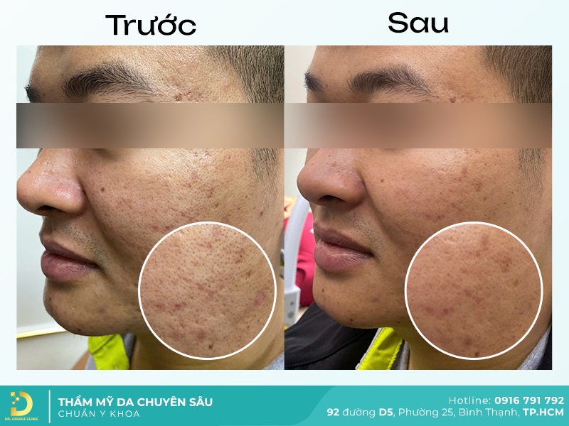 Lấy Nhân Mụn An Toàn, Hiệu Quả Chuẩn Y Khoa Tại TP.HCM 23 hinh anh ket qua lay nhan mun tai dr choice 1