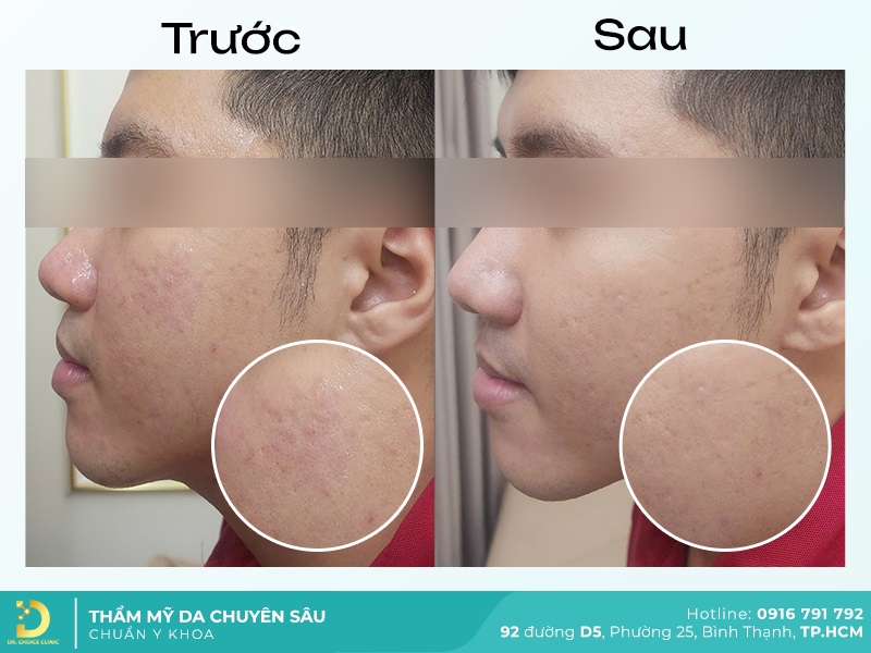 hinh anh ket qua lay nhan mun tai dr choice 2