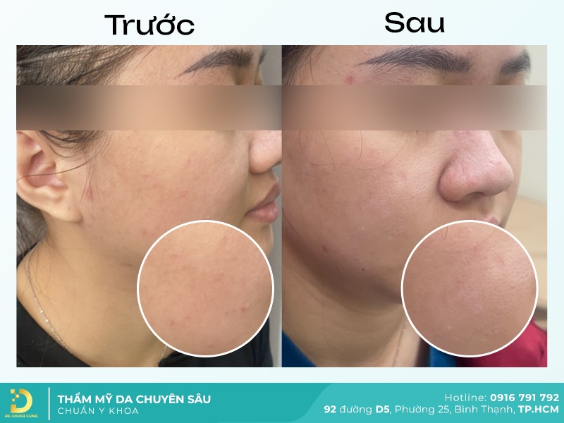 hinh anh ket qua lay nhan mun tai dr choice 4