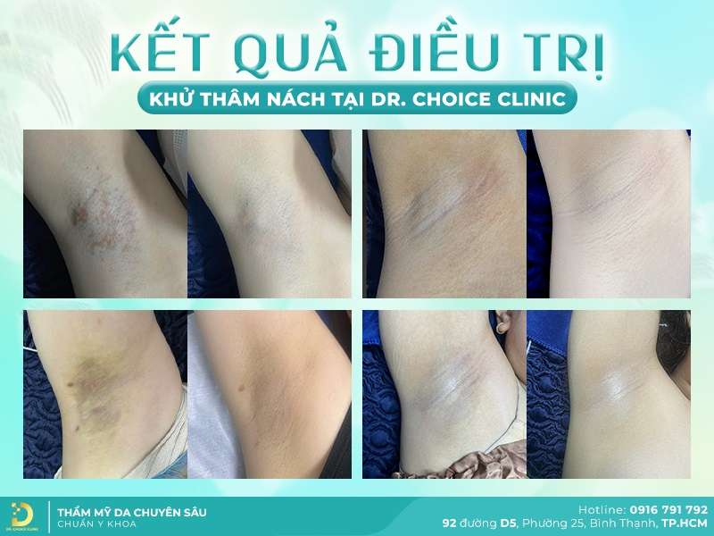 Kết quả trị thâm nách.