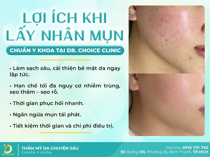 Lấy Nhân Mụn An Toàn, Hiệu Quả Chuẩn Y Khoa Tại TP.HCM 14 Lợi ích khi lấy nhân mụn chuẩn y khoa từ Dr Choice Clinic