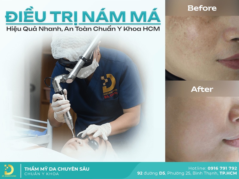 điều trị nám da