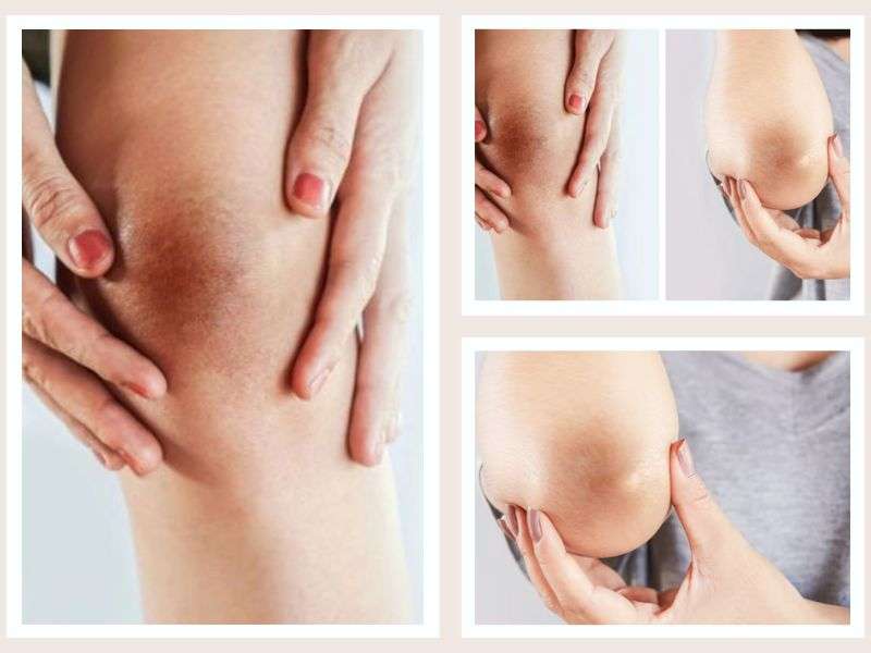 Nguyên nhân thâm tại các vùng khủy tay, khủy chân, đầu gối, mắt cá chân