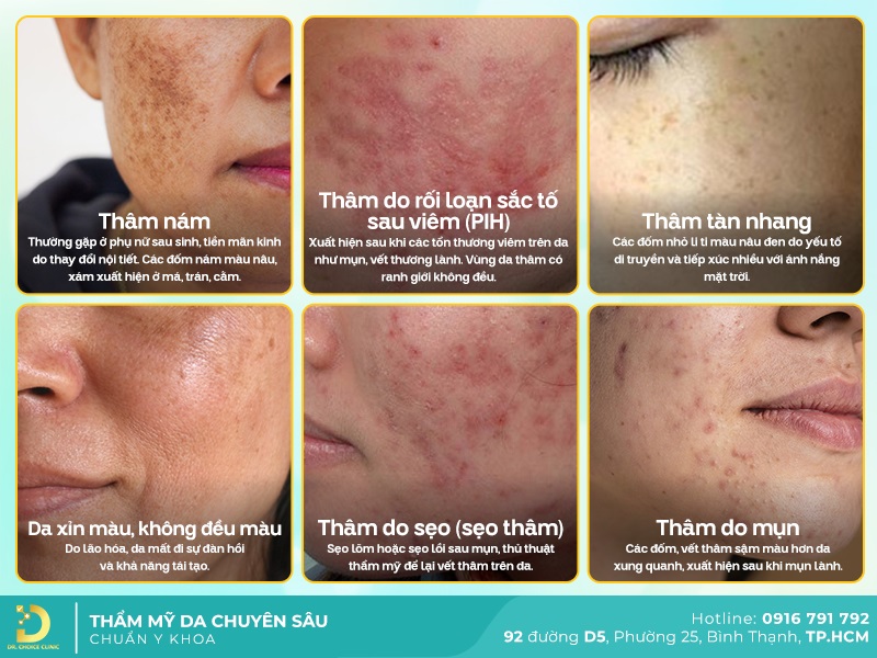 Dịch Vụ Điều Trị Thâm Mặt Chuẩn Y Khoa, An Toàn Tại TP.HCM 10 Các dạng thâm mặt phổ biến