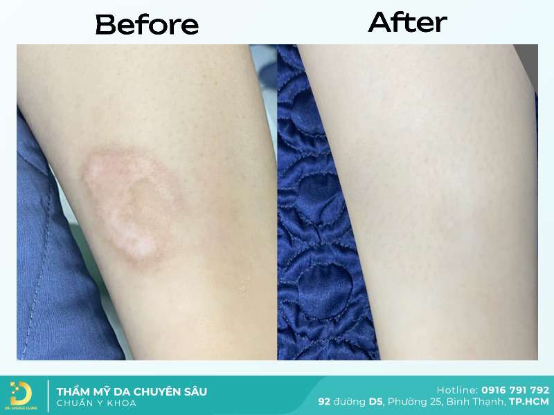 Trị sẹo 