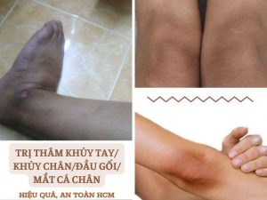 Trị thâm khủy tay/khủy chân/đầu gối/mắt cá chân