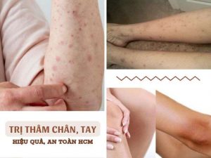 Trị thâm chân, tay