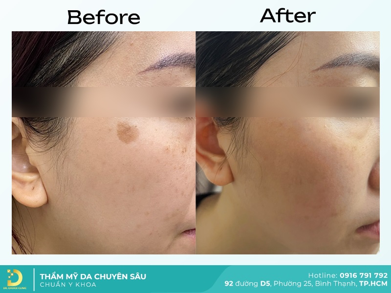 truoc va sau tri bot sac to 1