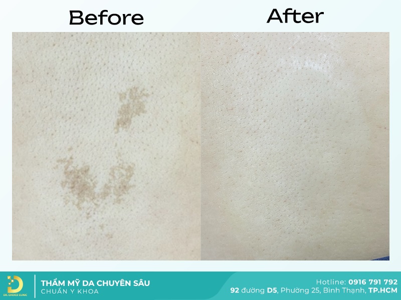 truoc va sau tri bot sac to 2