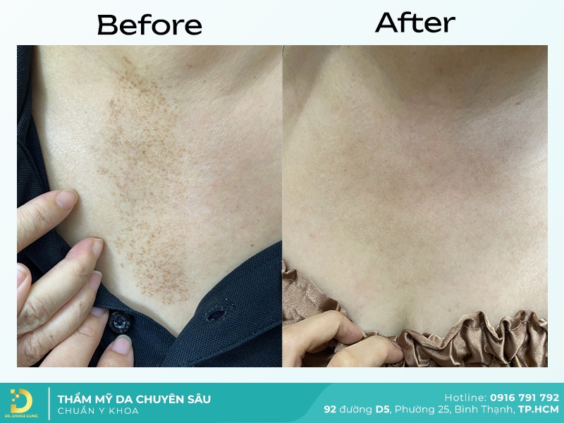 truoc va sau tri bot sac to 3