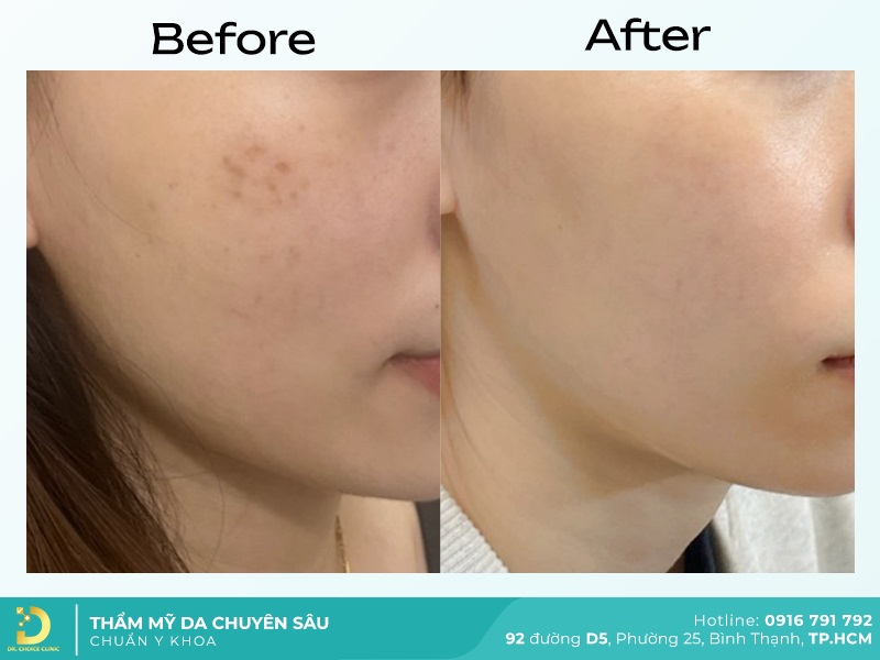 truoc va sau tri bot sac to 4