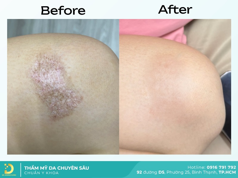 truoc va sau tri seo trang 2