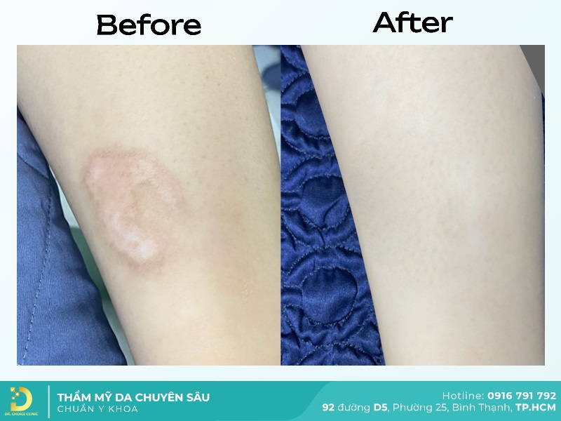 Điều Trị Sẹo Mất Sắc Tố (Sẹo Trắng) Nhanh Chóng, An Toàn HCM 23 truoc va sau tri seo trang 5