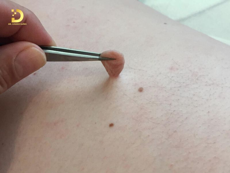 Điều Trị U Treo Mềm Nhanh Chóng, An Toàn HCM 8 Không nên tự cắt u mềm treo tại nhà