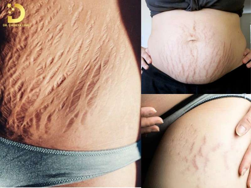 Nguyên nhân gây rạn da 