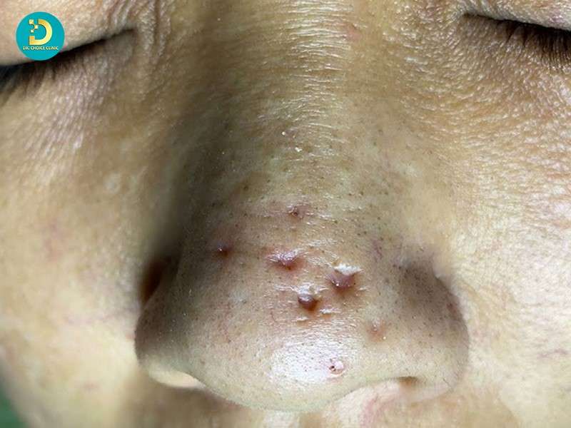 Sẹo Rỗ Ở Mũi: Nguyên Nhân & Cách Điều Trị Hiệu Quả 19 Bóc tách đáy sẹo bằng ống Cannula để phá vỡ các dải xơ dưới đáy sẹo