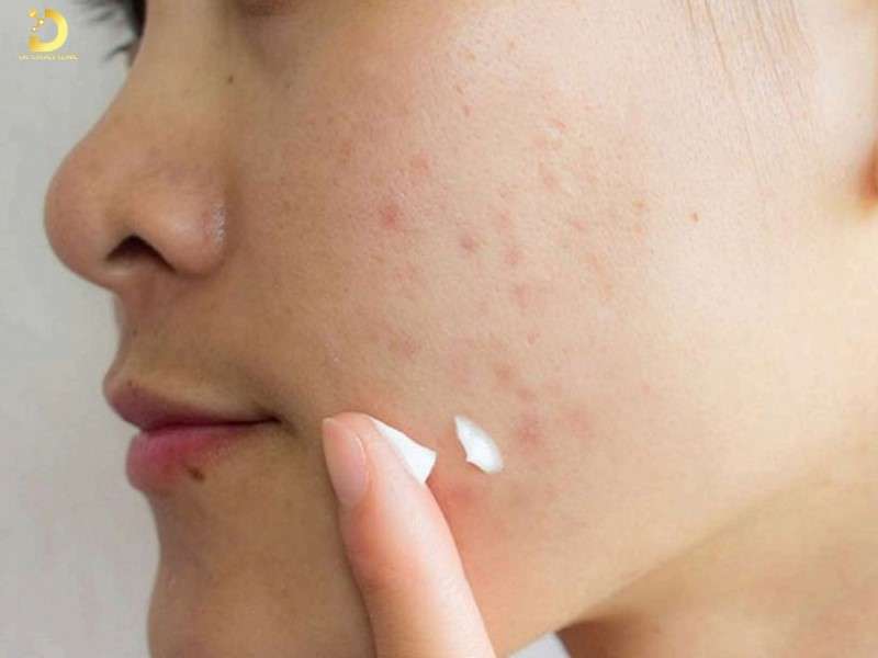 Bôi kem trị sẹo và các sản phẩm hỗ trợ da