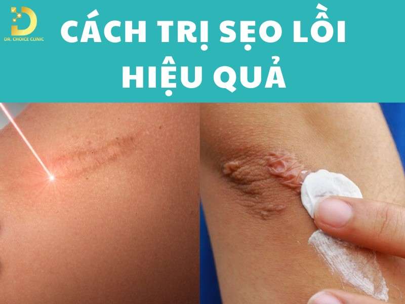 Trị sẹo lồi