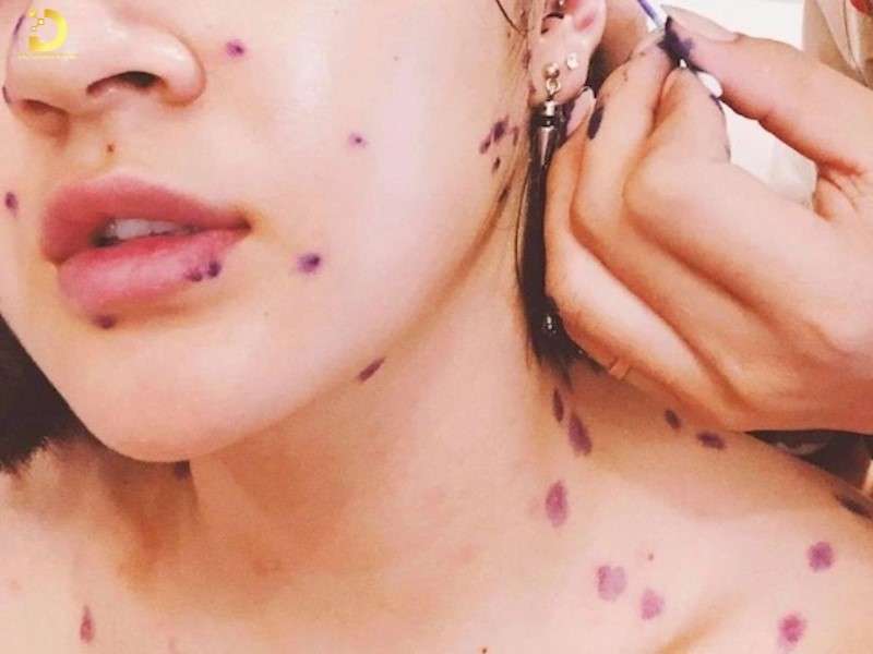 Giai đoạn cấp tính 