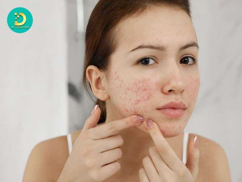 Cơ chế hình thành sẹo đáy tròn từ mụn trứng cá