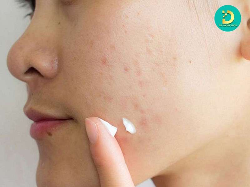 Điều trị sẹo tại chỗ