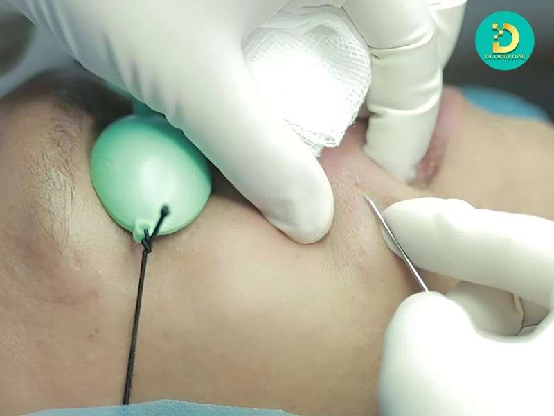 Điều trị sẹo xâm lấn