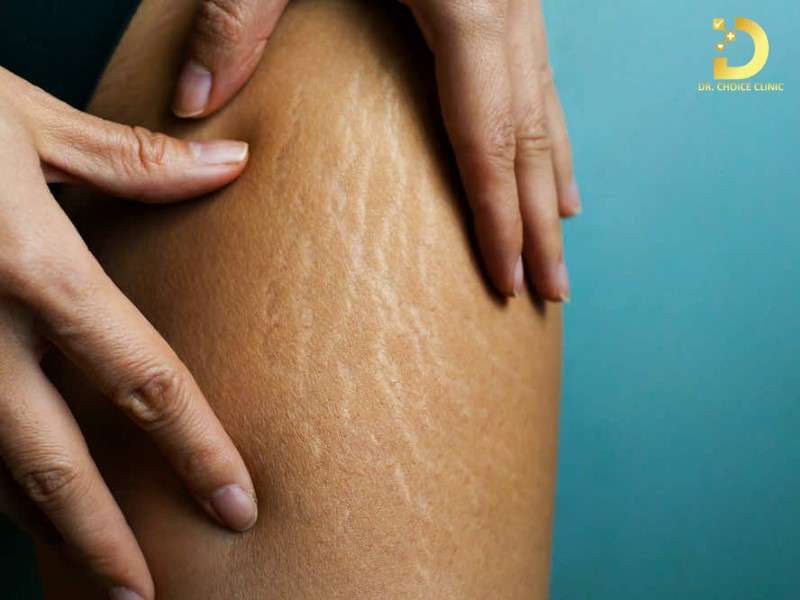 Hiểu rõ hơn về rạn da là gì