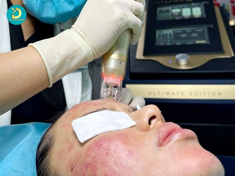 Sẹo Rỗ Ở Mũi: Nguyên Nhân & Cách Điều Trị Hiệu Quả 20 Lăn kim – Vi kim RF – Dermapen kích thích quá trình tự lành và tăng sinh collagen